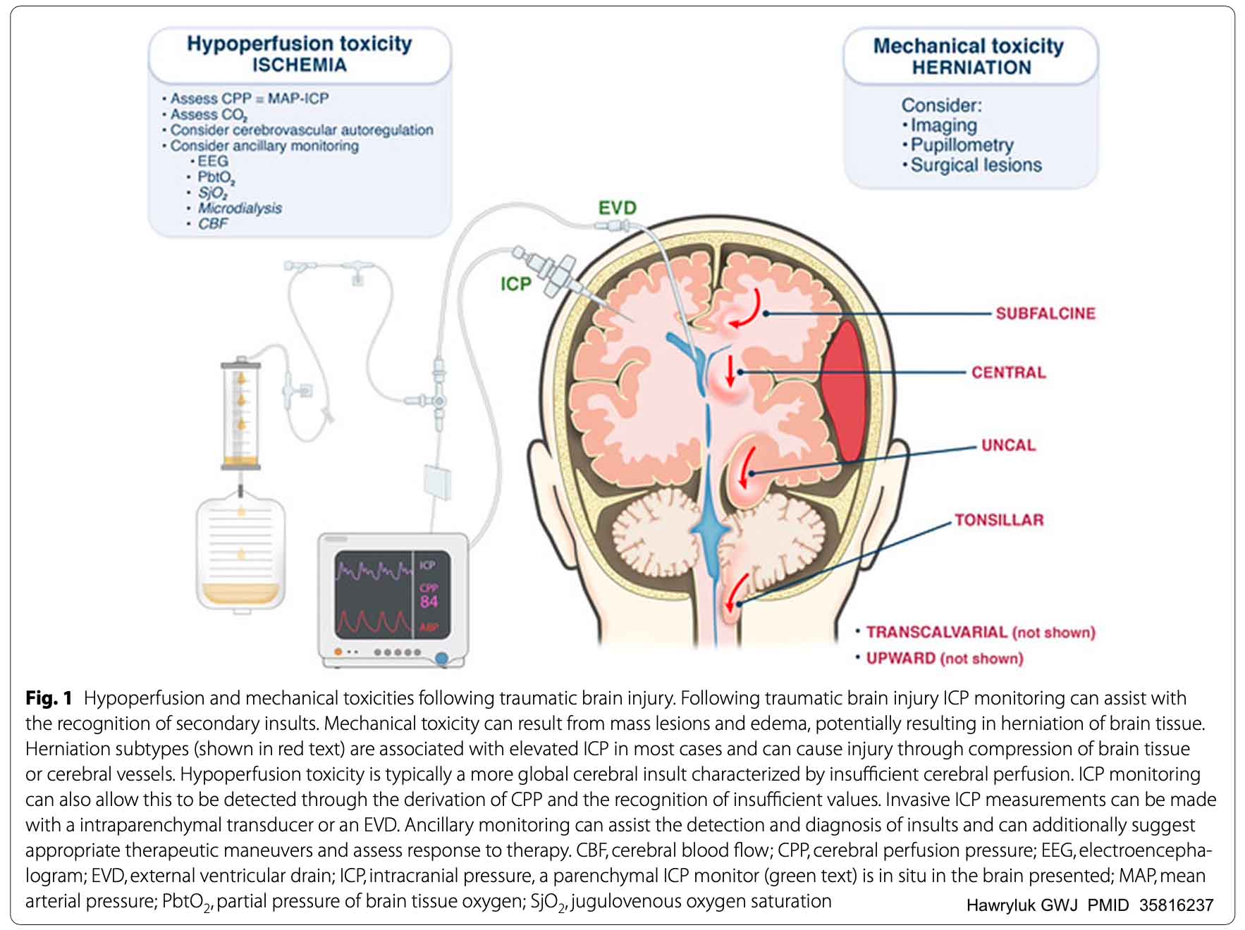 A Trial of Intracranial-Pressure Monitoring in Traumatic Brain Injury