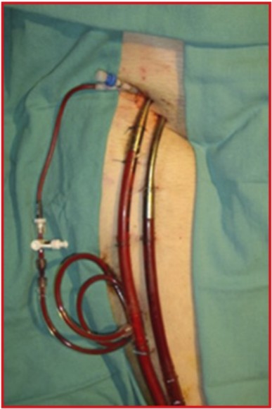 Resuscitative Extra-Corporeal Life Support (ECMO) in the ED